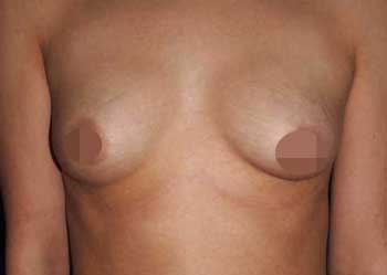 Tubuläre Brust